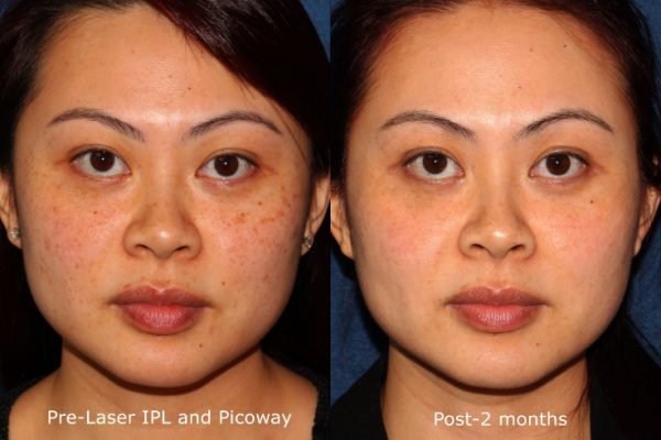 How Much is CO2 Laser Skin Resurfacing?