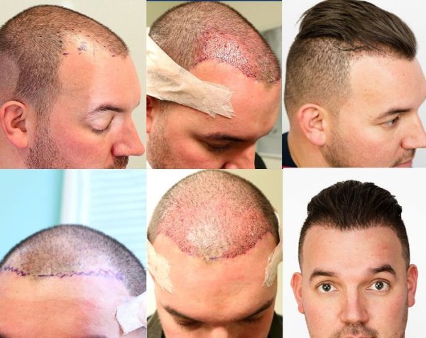 How Much Does A Hair Transplant Cost In Turkey?